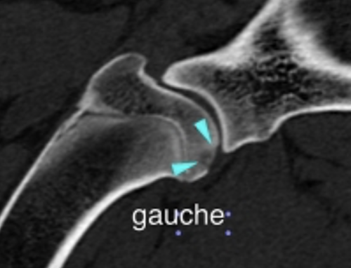 Arthroscopie de l'épaule avec fragments ostéochondraux dans la coulisse biccipitale