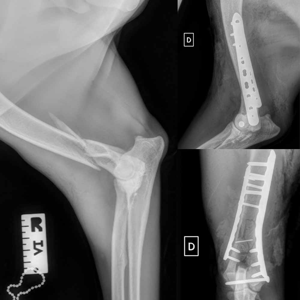 Question du mois : Conduite à tenir face à une fracture humérale en Y ou en T