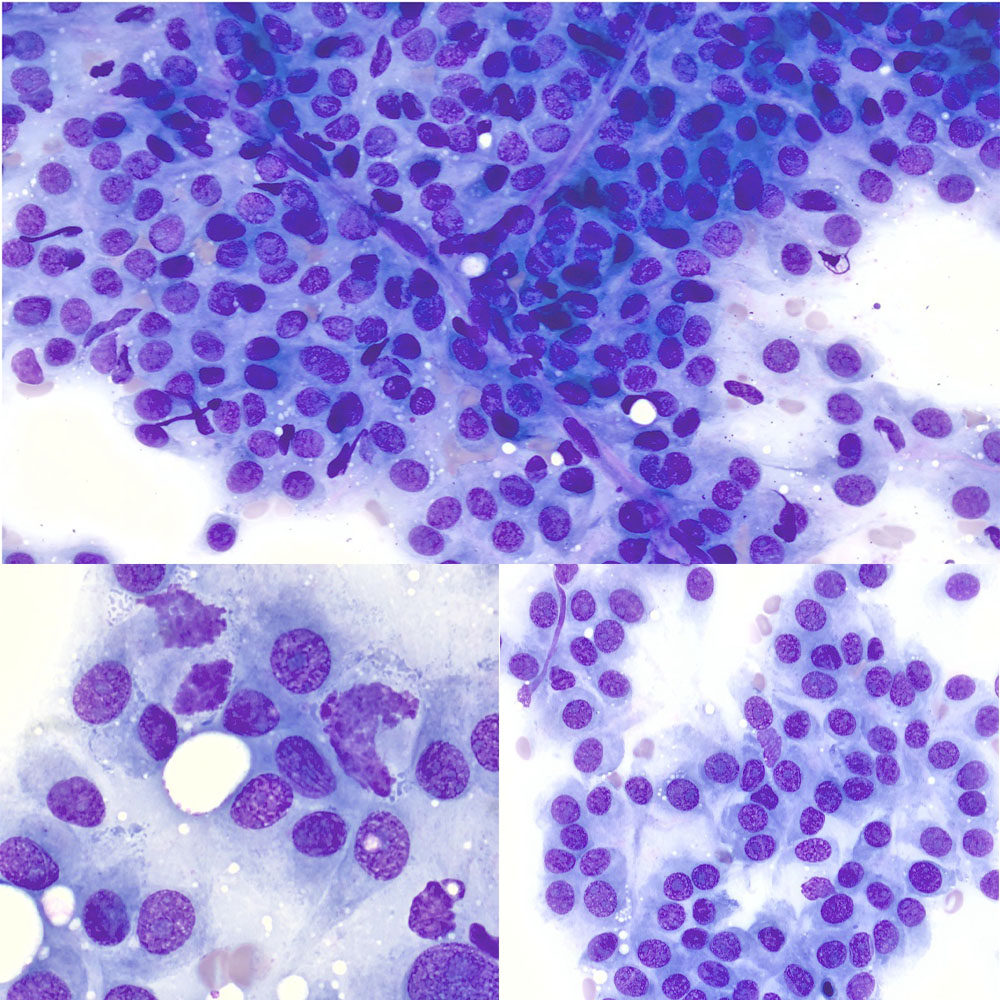 Quizz du mois : Que voyez-vous dans cette cytoponction à l’aiguille fine ?