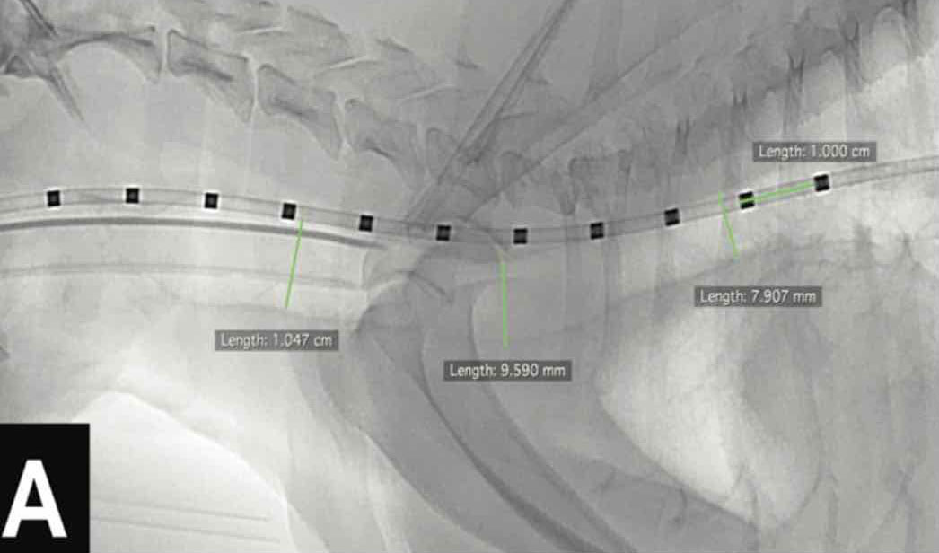 Revues sur les cholélithiases et les stents trachéaux