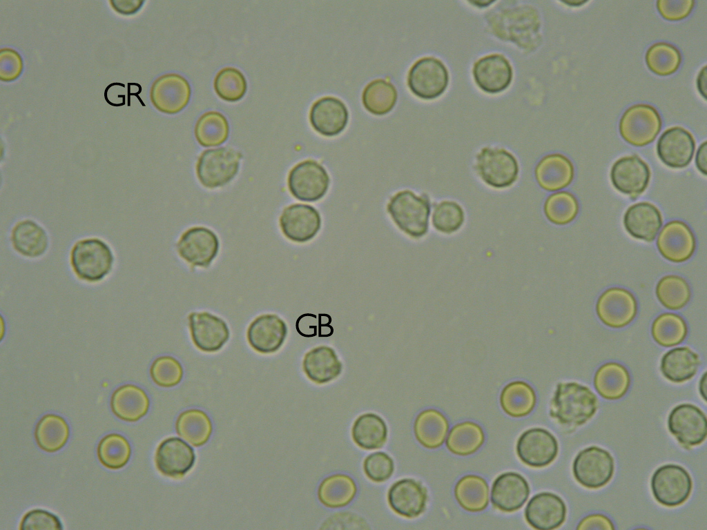 Intérêt de la cytologie du LCR lors d'épilepsie essentielle