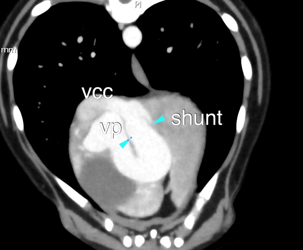 Shunt intrahépatique G traité par voie endovasculaire