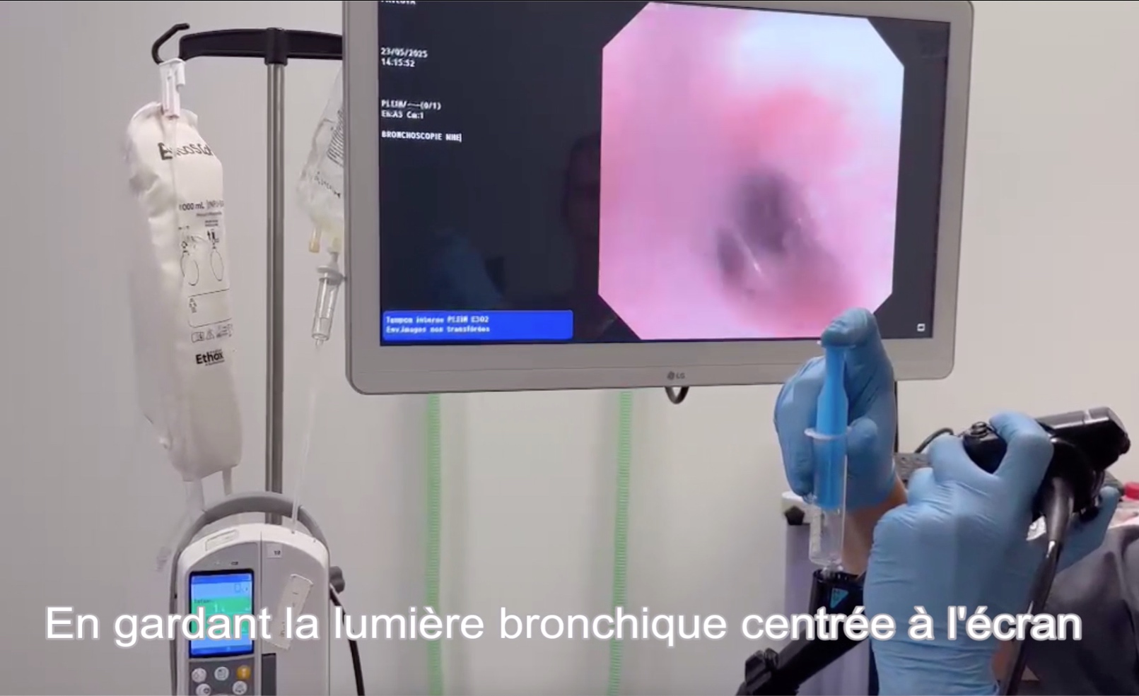Réaliser un lavage broncho-alvéolaire