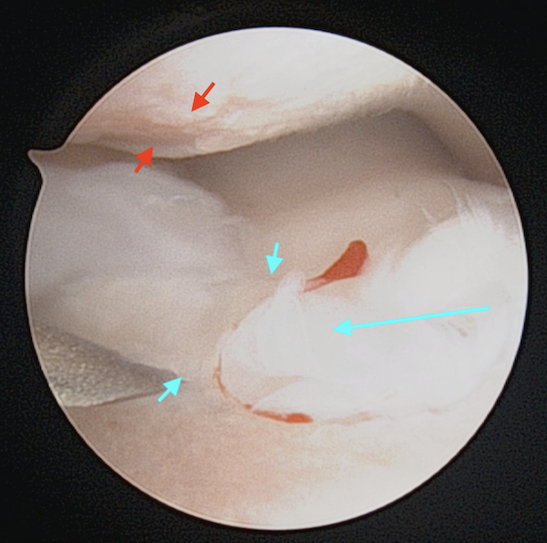 Scanner et arthroscopie lors de dysplasie des coudes