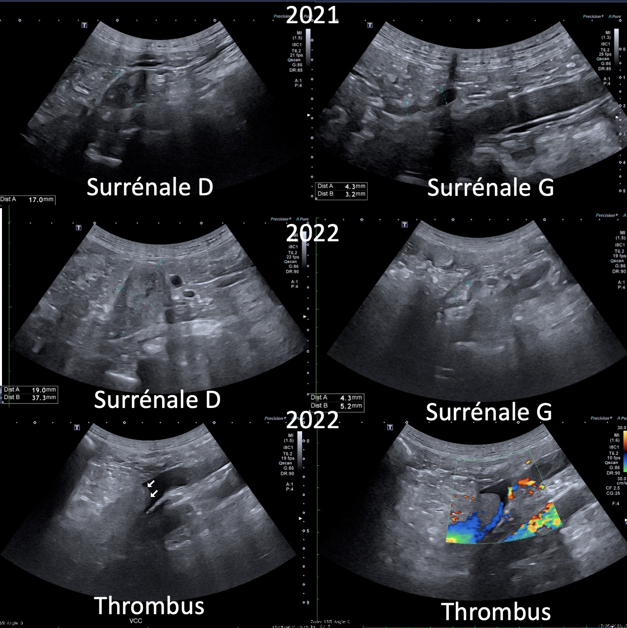 Tumeur surrénalienne avec thrombus cave