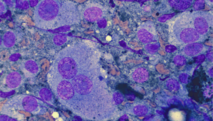 Cytologie de mélanome