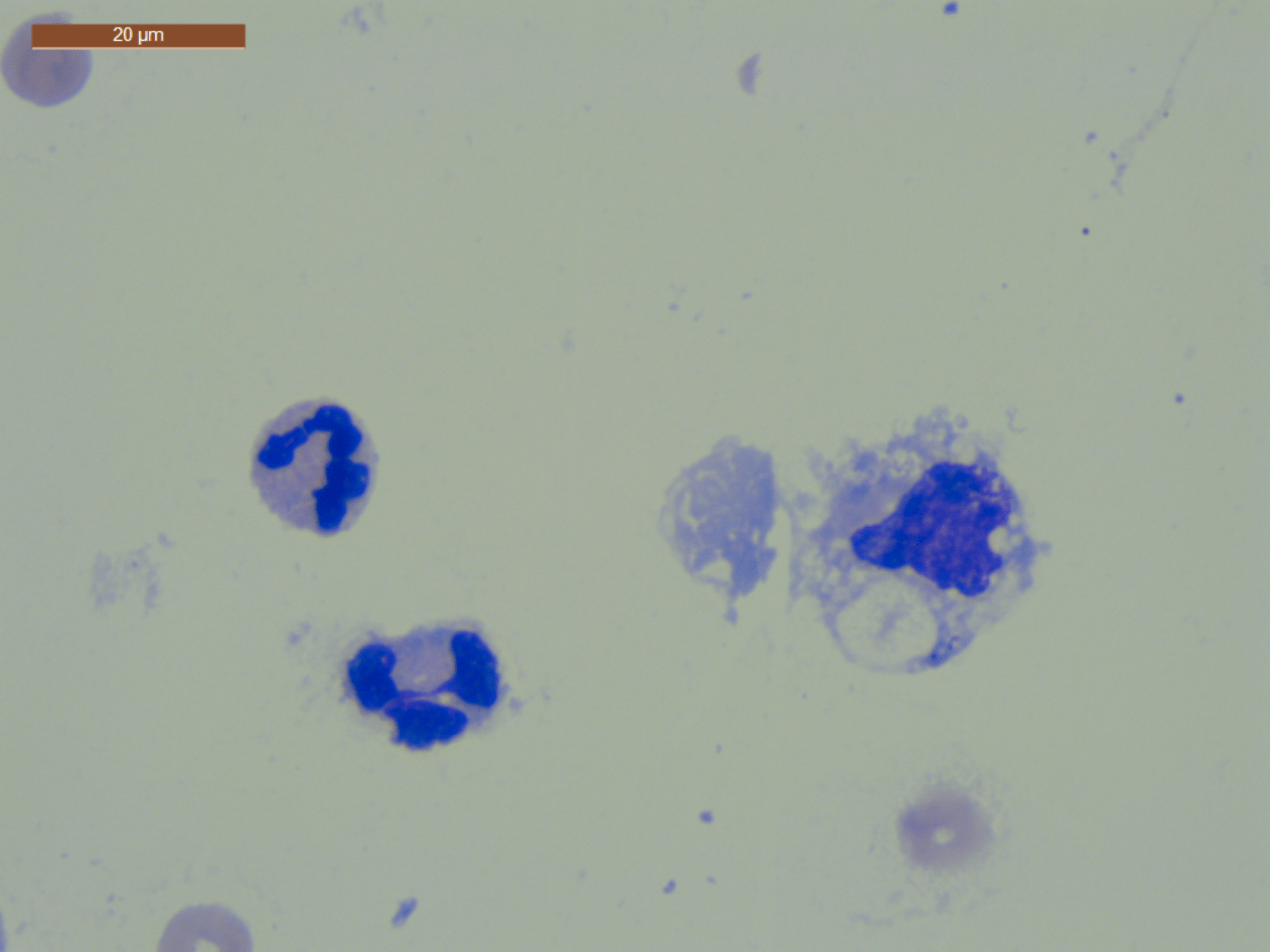 Intérêt de la cytologie du LCR lors d&rsquo;épilepsie essentielle