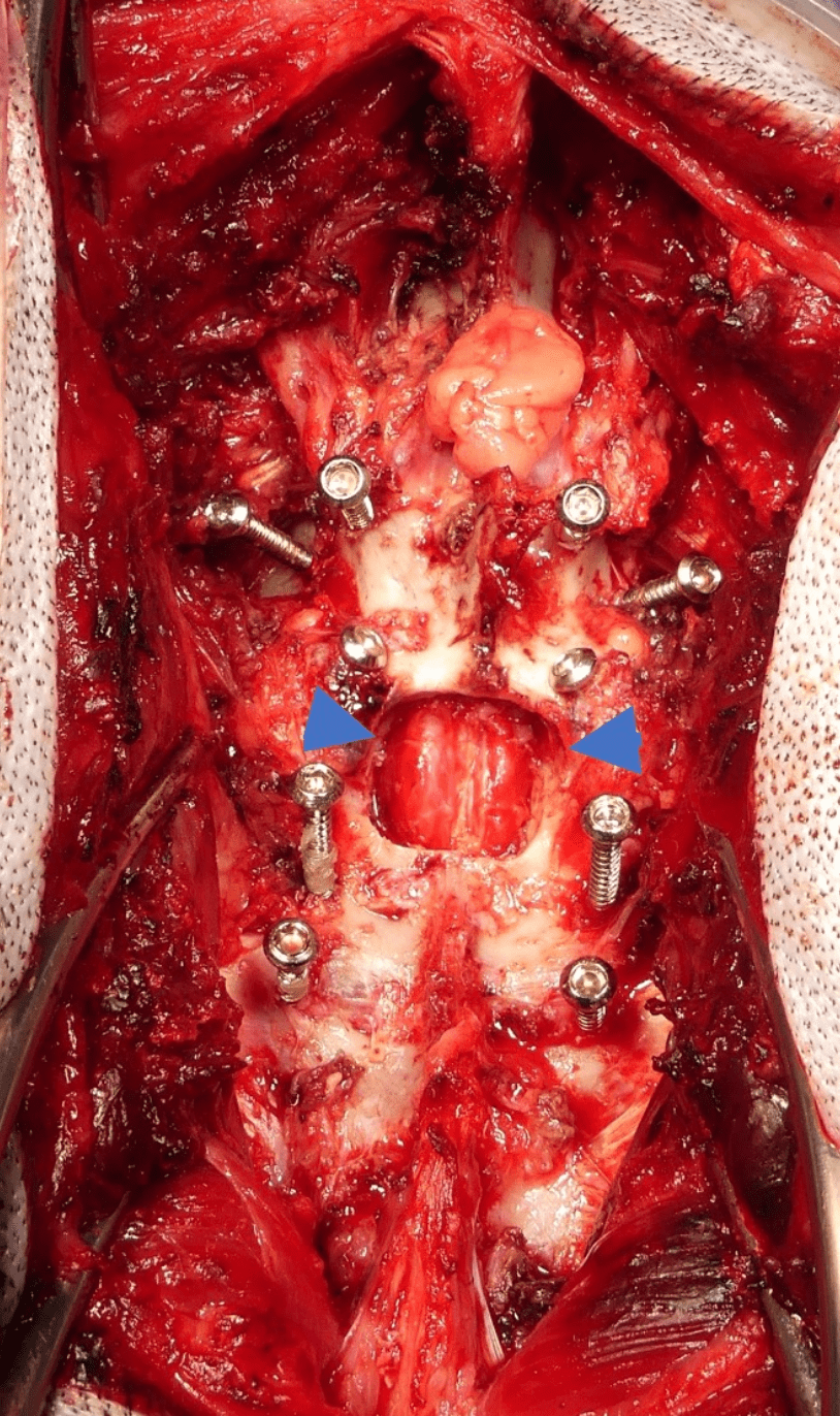 Chirurgie lors d&rsquo;instabilité lombosacrée