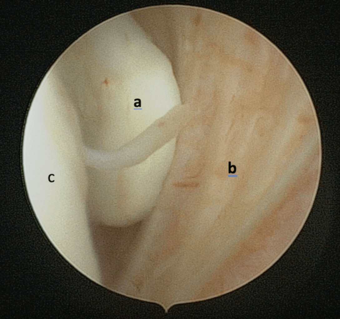 Arthroscopie de l&rsquo;épaule avec fragments ostéochondraux dans la coulisse biccipitale