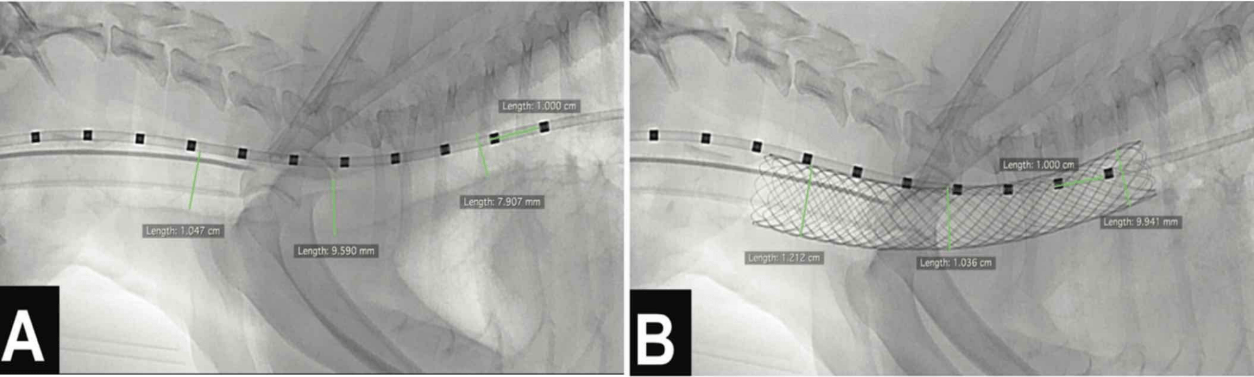 Revues sur les cholélithiases et les stents trachéaux